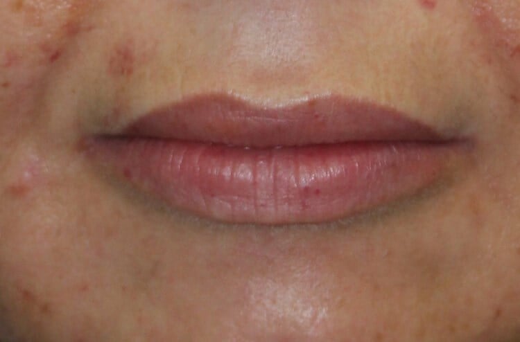 Fat Injection to Lip After