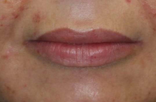 Fat Injection to Lip After
