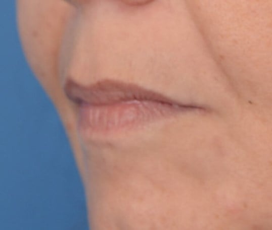 Fat Injection to Lip Before