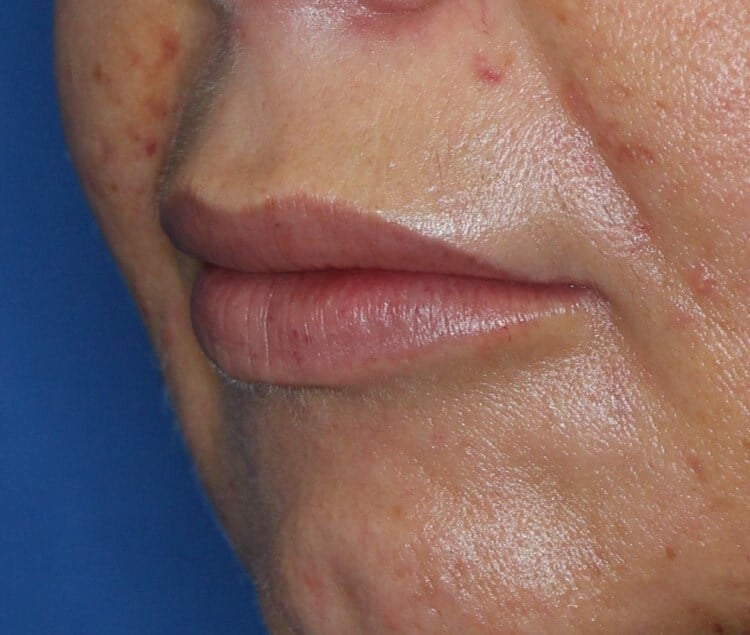 Fat Injection to Lip After