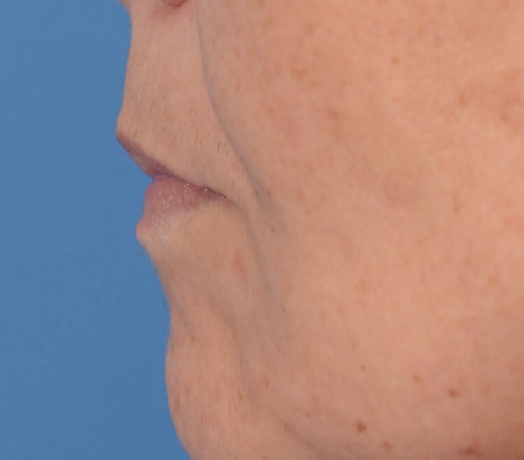 Fat Injection to Lip Before