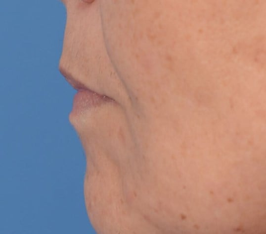 Fat Injection to Lip Before