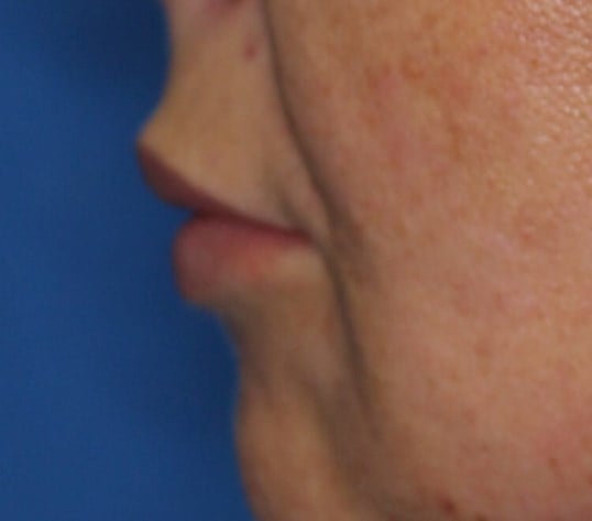 Fat Injection to Lip After