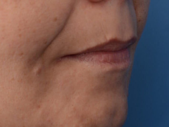 Fat Injection to Lip Before