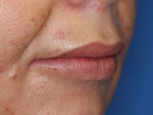 Fat Injection to Lip After