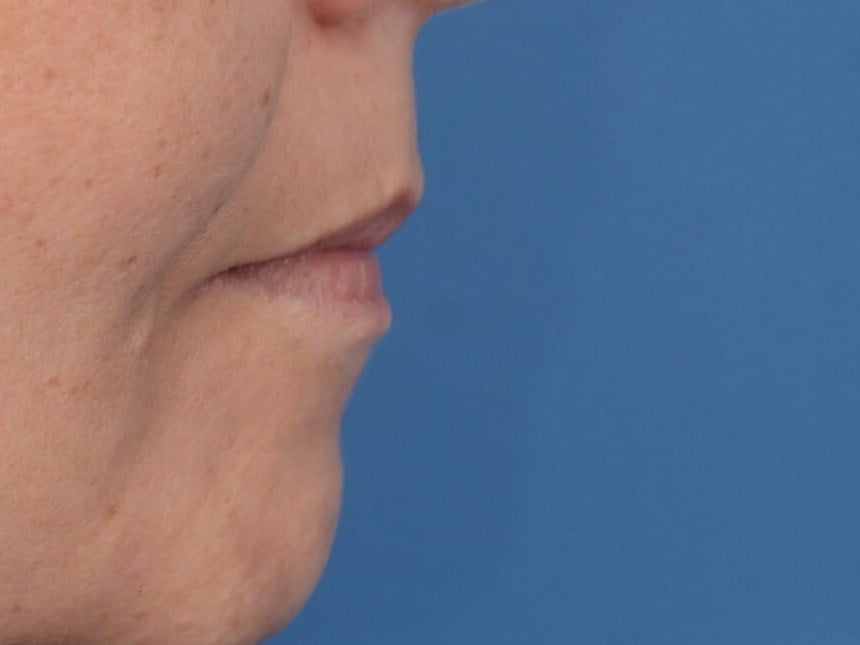 Fat Injection to Lip Before