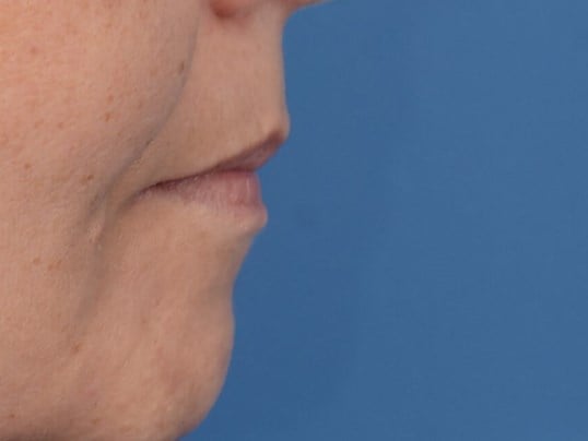 Fat Injection to Lip Before