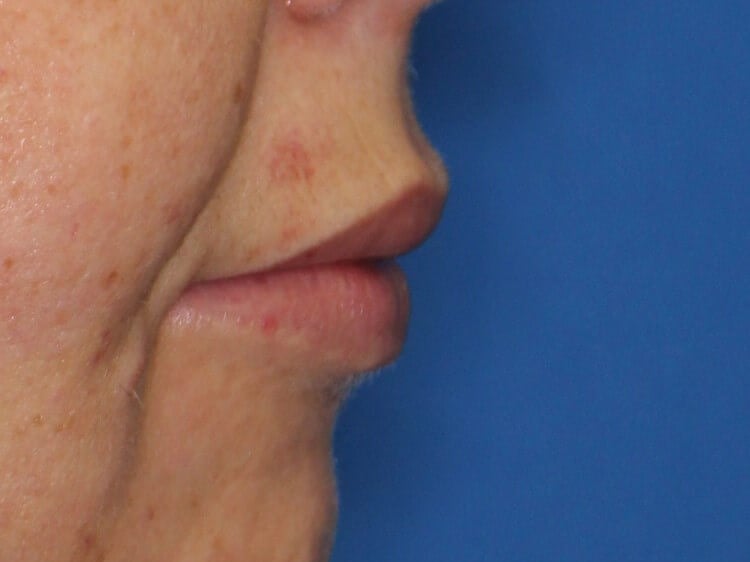 Fat Injection to Lip After