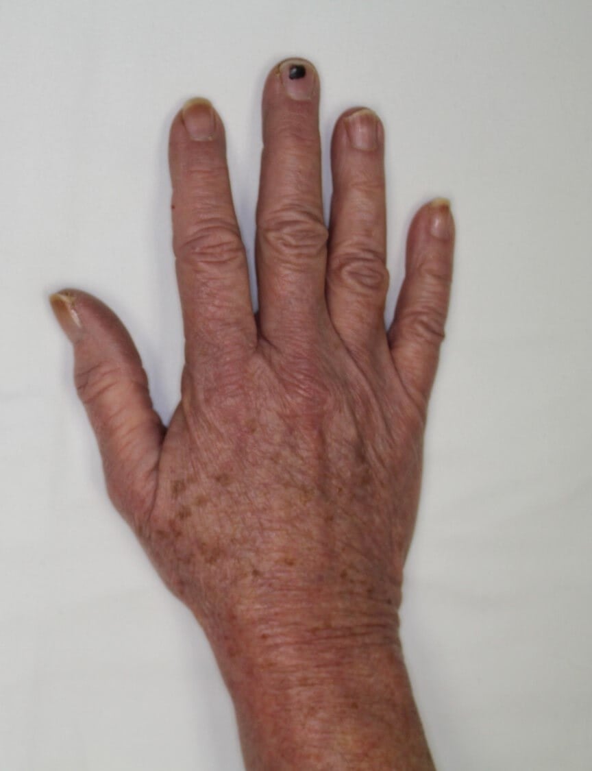 Fat Injection to Hands After