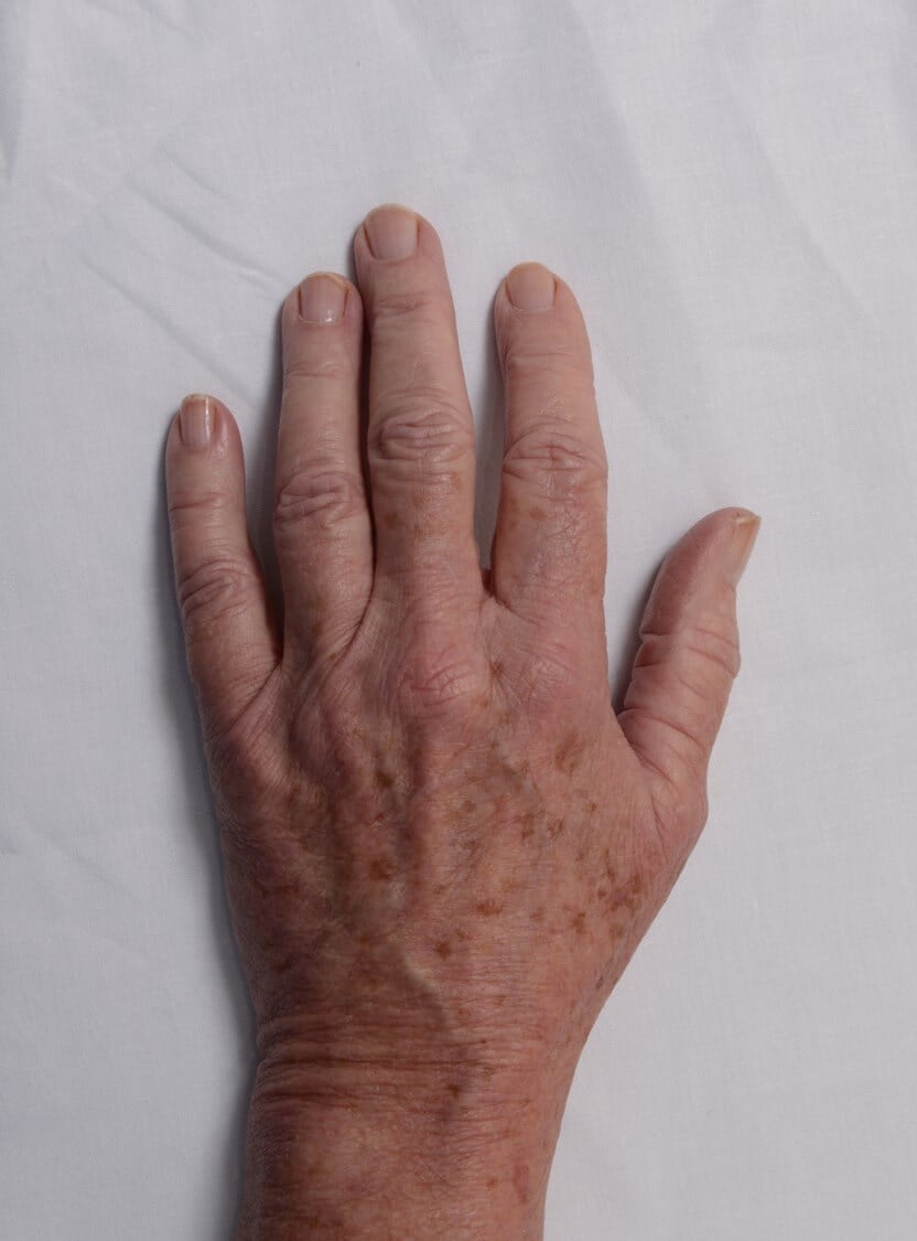 Fat Injection to Hands Before