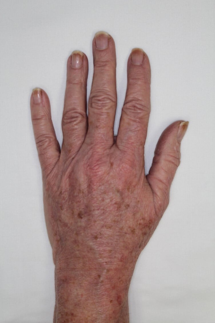 Fat Injection to Hands After