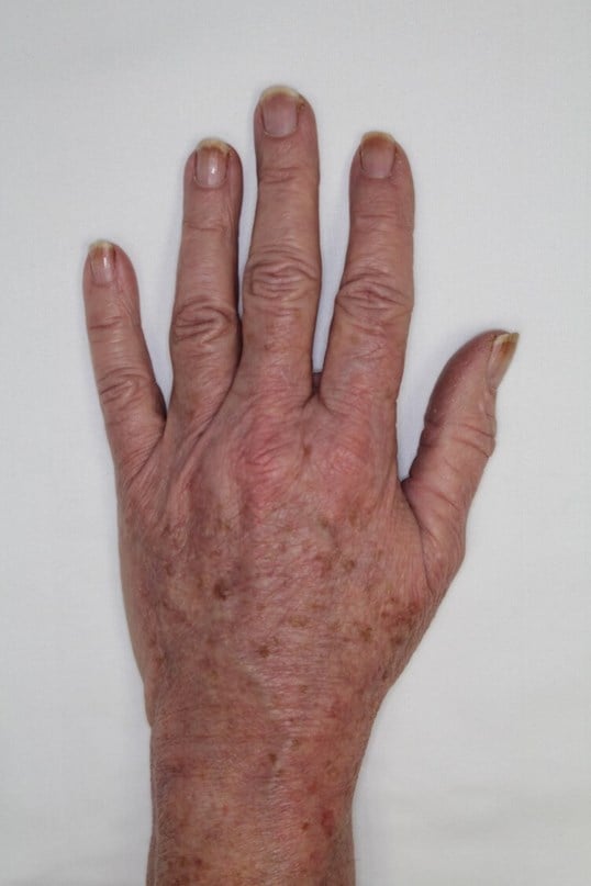 Fat Injection to Hands After