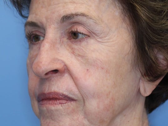 Fat Transfer to Face Before