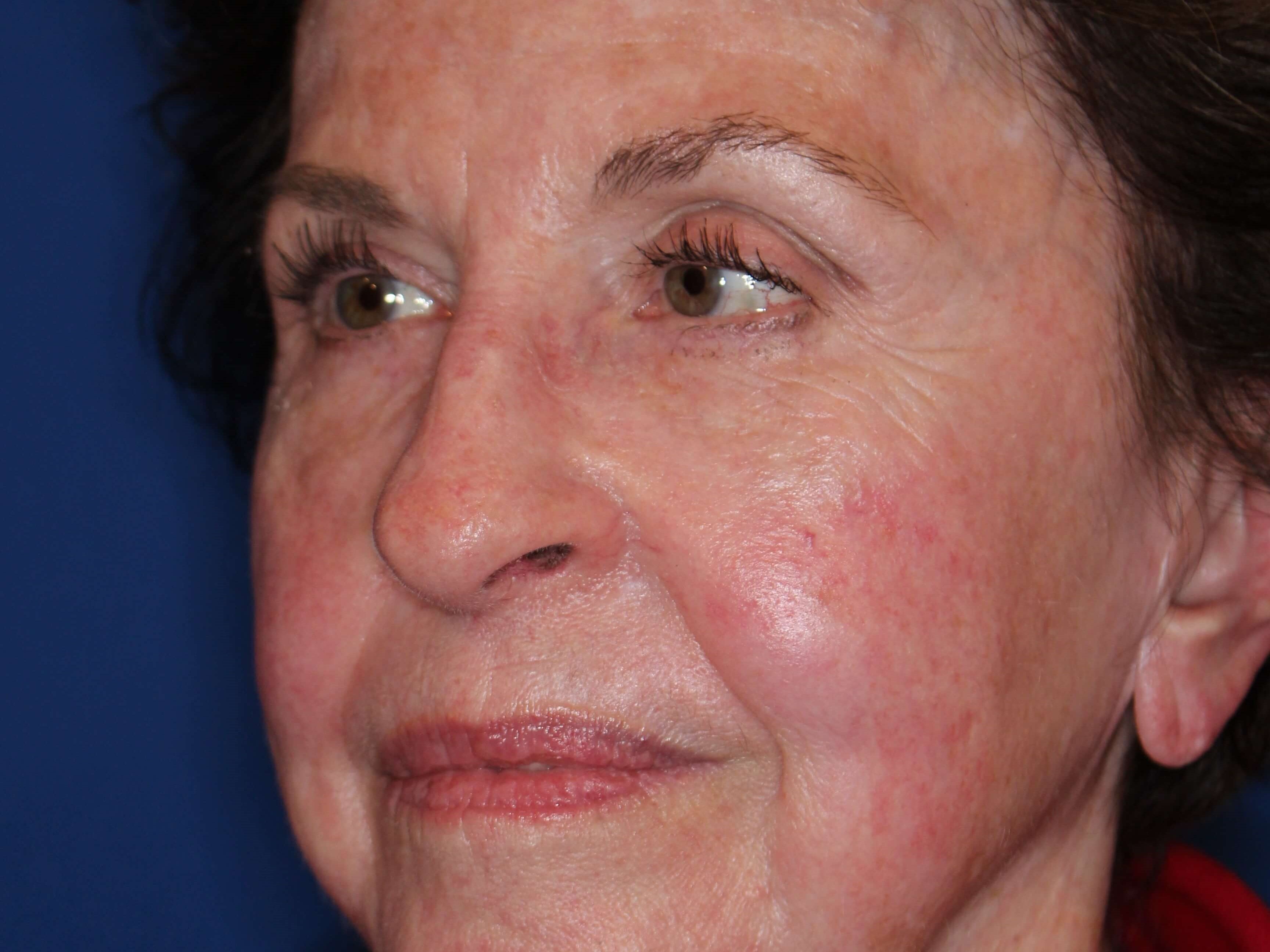 Fat Transfer to Face After