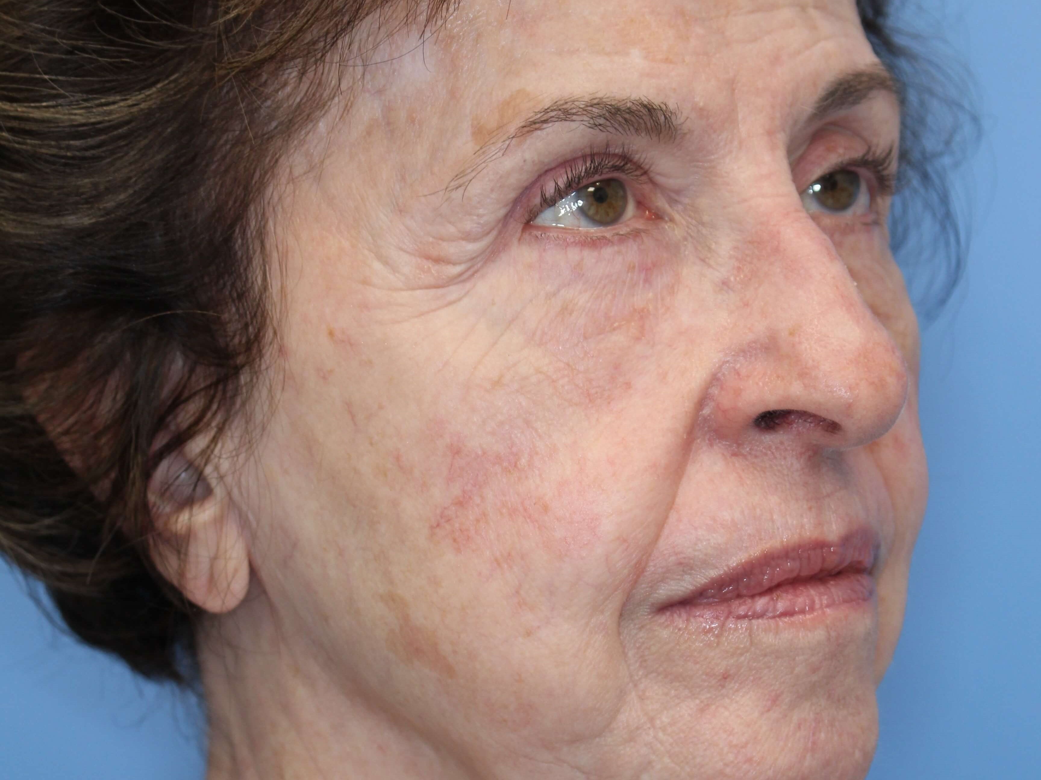 Fat Transfer to Face Before