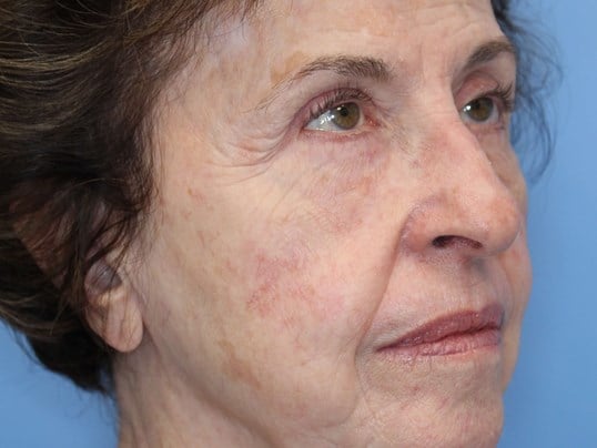 Fat Transfer to Face Before