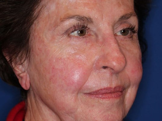 Fat Transfer to Face After