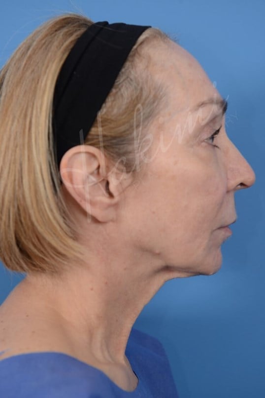 Neck Lift Before
