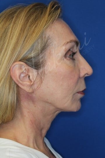 Neck Lift After