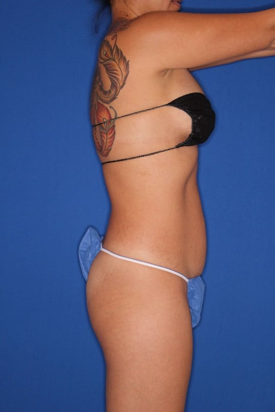 Awake Liposuction of Abdomen Before