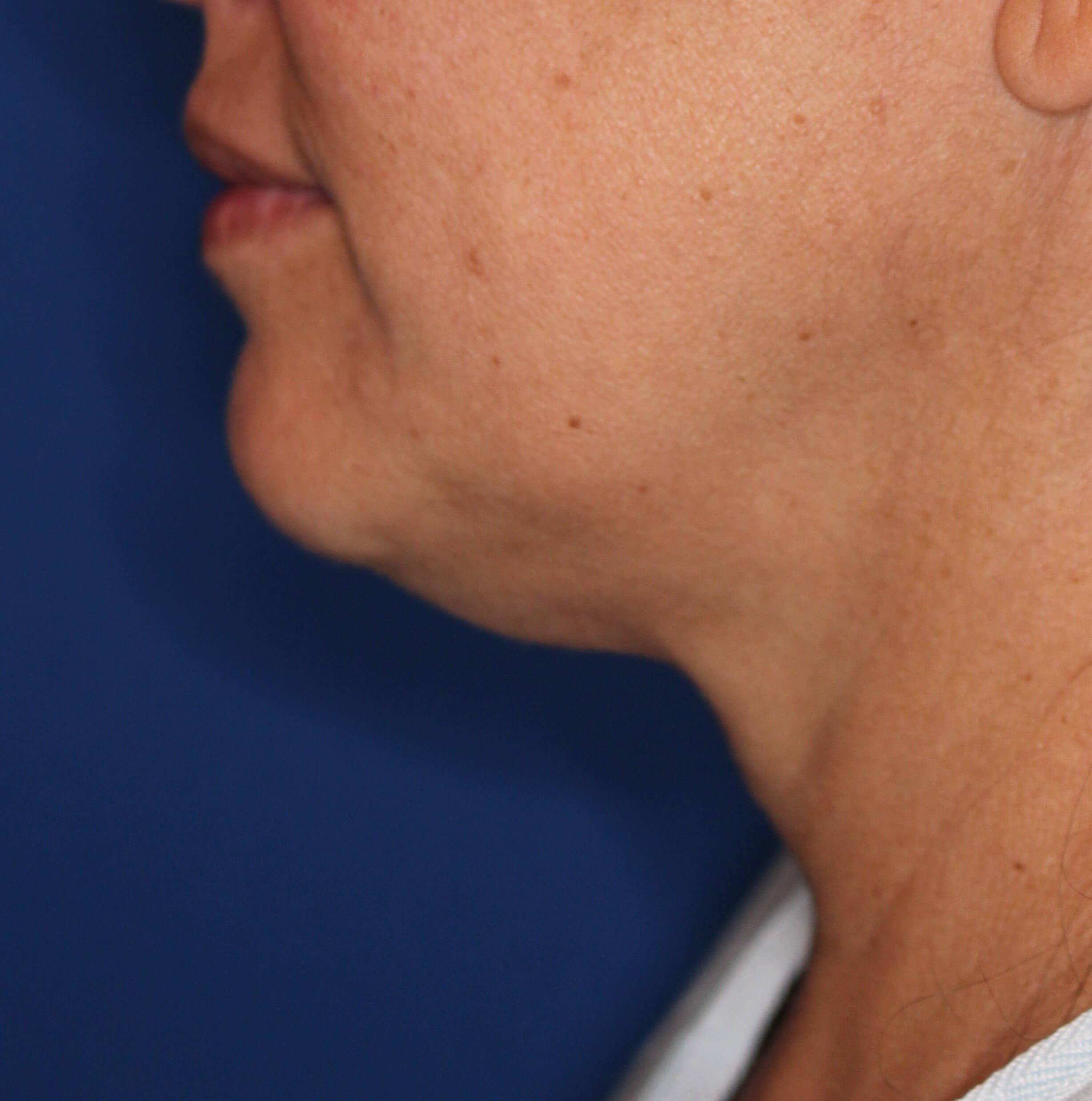 RF Skin Tightening Before