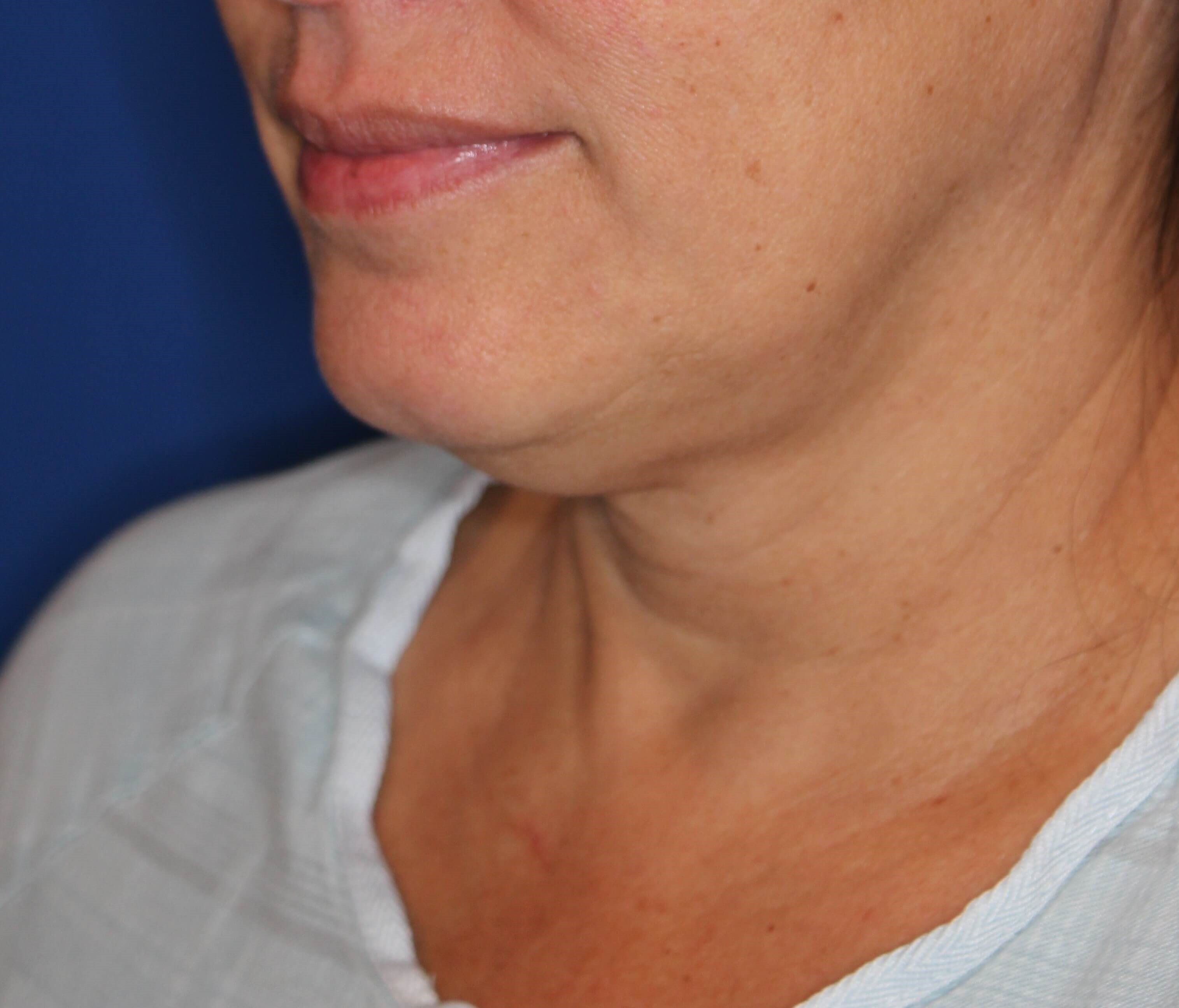 RF Skin Tightening Before