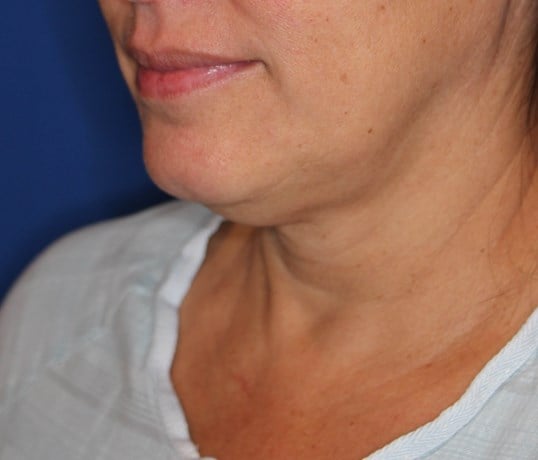 RF Skin Tightening Before