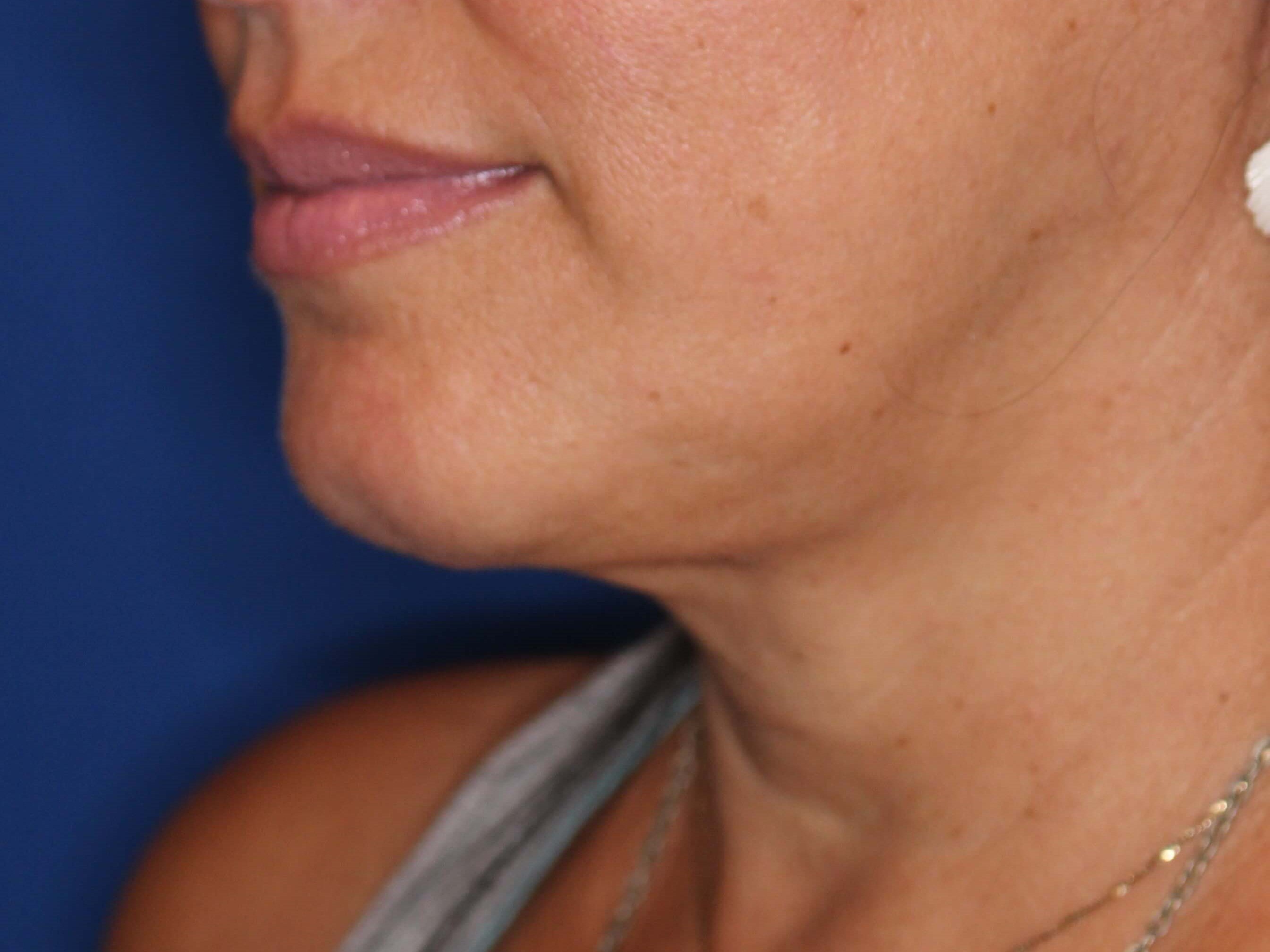 RF Skin Tightening After