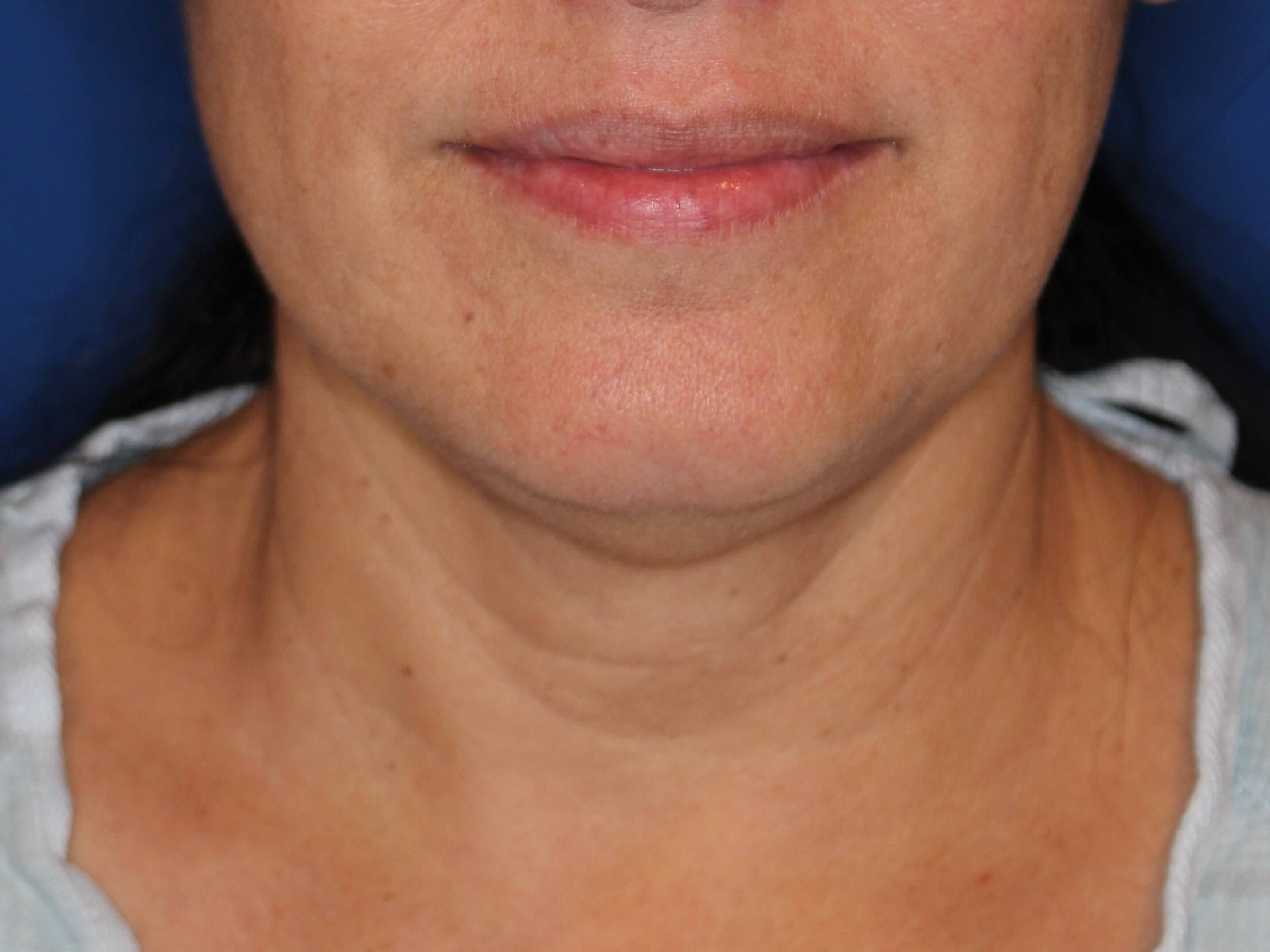 RF Skin Tightening Before