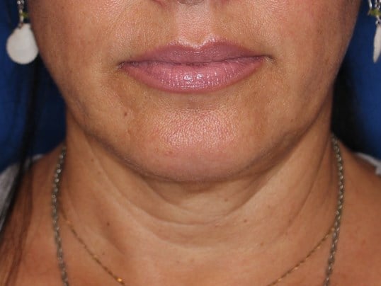 RF Skin Tightening After