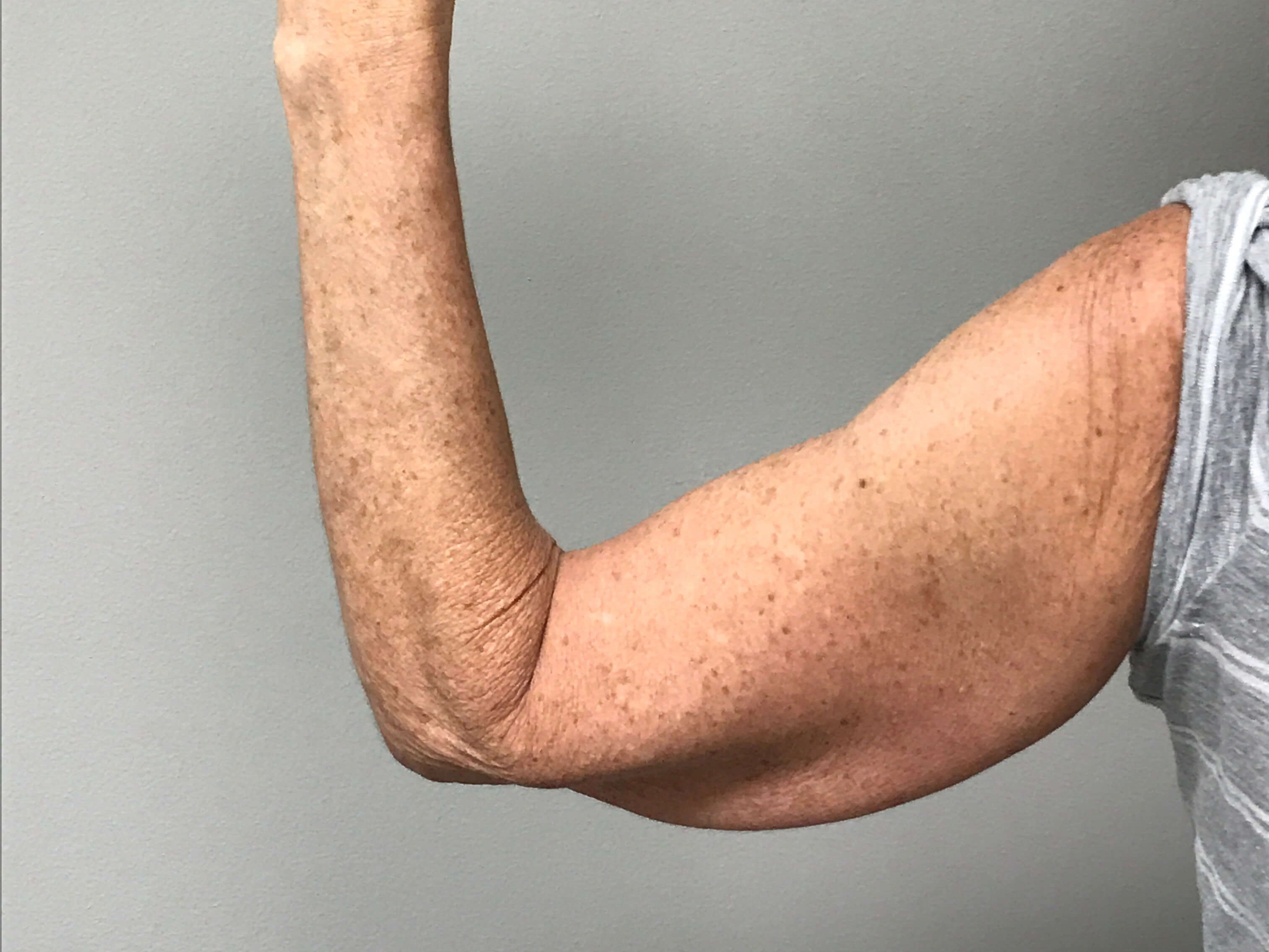 Nonsurgical Skin Tightening Before