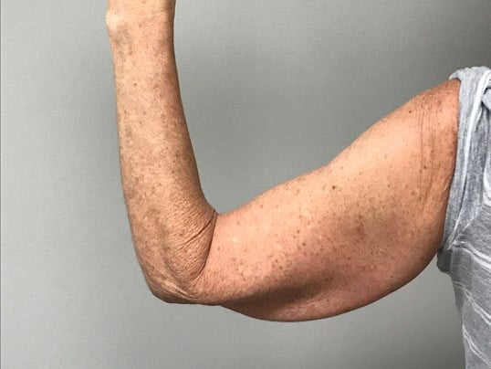 Nonsurgical Skin Tightening Before