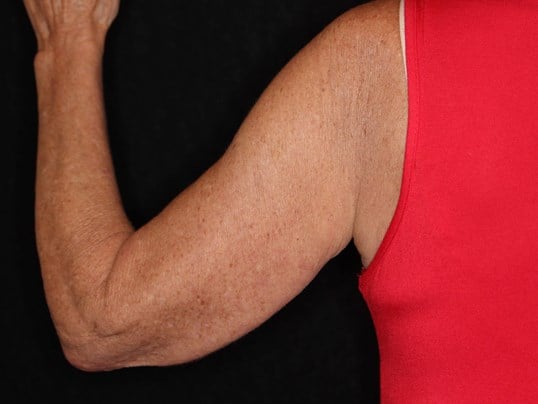 Nonsurgical Skin Tightening After