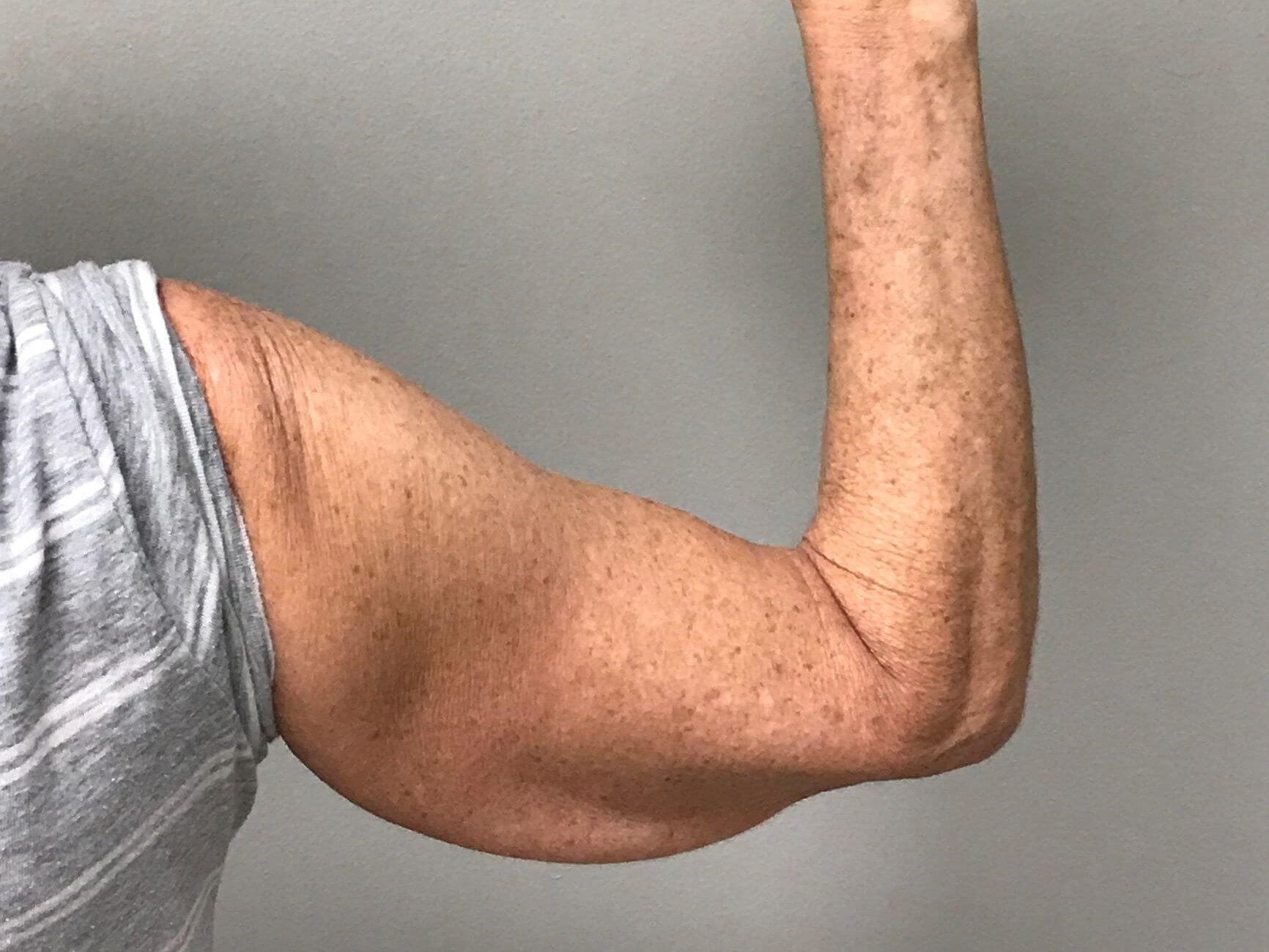 Nonsurgical Skin Tightening Before