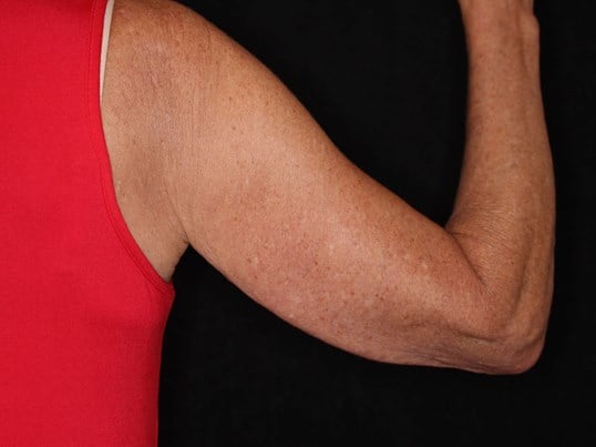 Nonsurgical Skin Tightening After