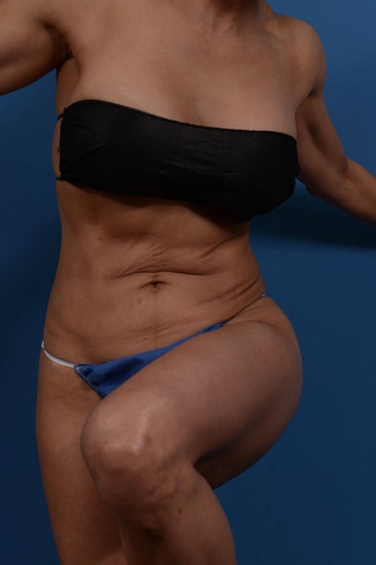 Nonsurgical Skin Tightening Before