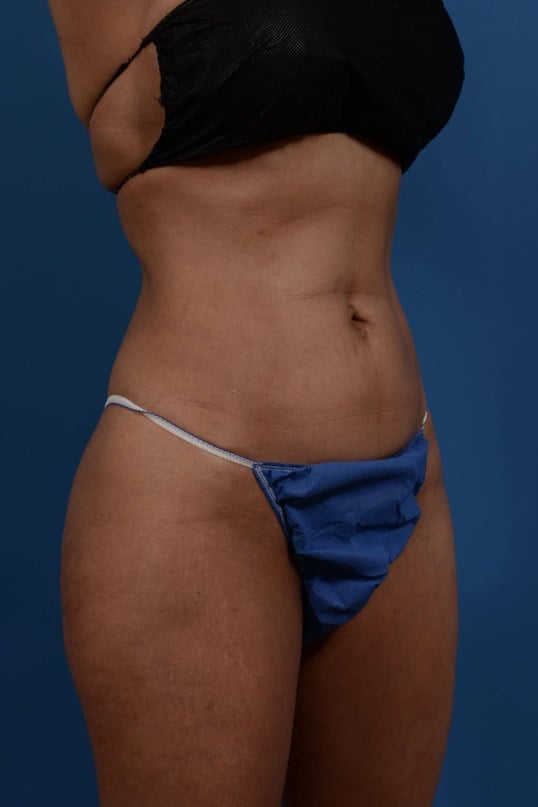 Nonsurgical Skin Tightening Before