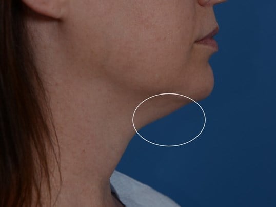 Radiofrequency Skin tightening Before