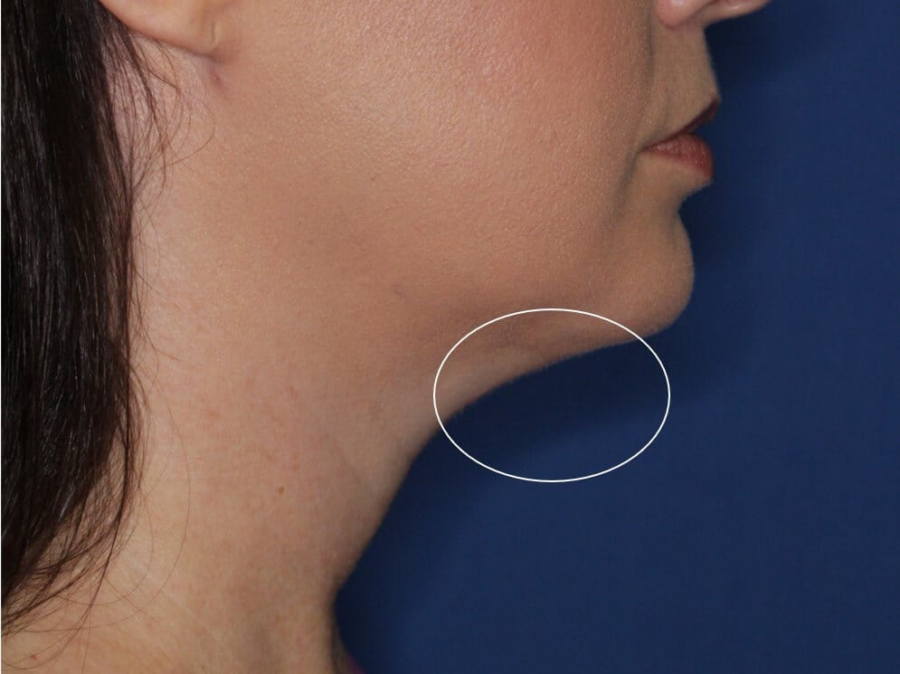 Radiofrequency Skin tightening After