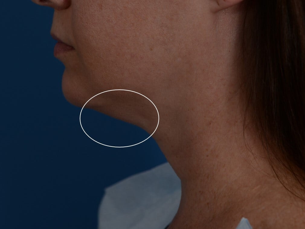 Radiofrequency Skin tightening Before