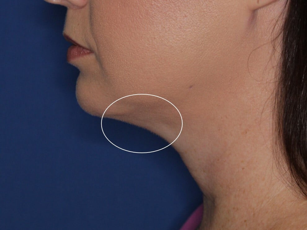 Radiofrequency Skin tightening After