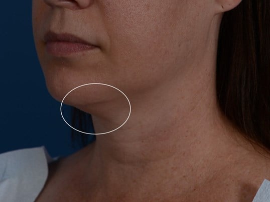 Radiofrequency Skin tightening Before