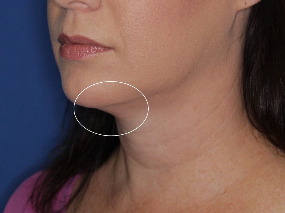 Radiofrequency Skin tightening After