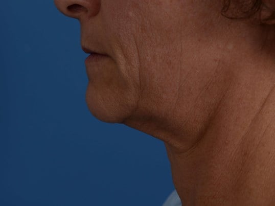 Radiofrequency Skin tightening Before