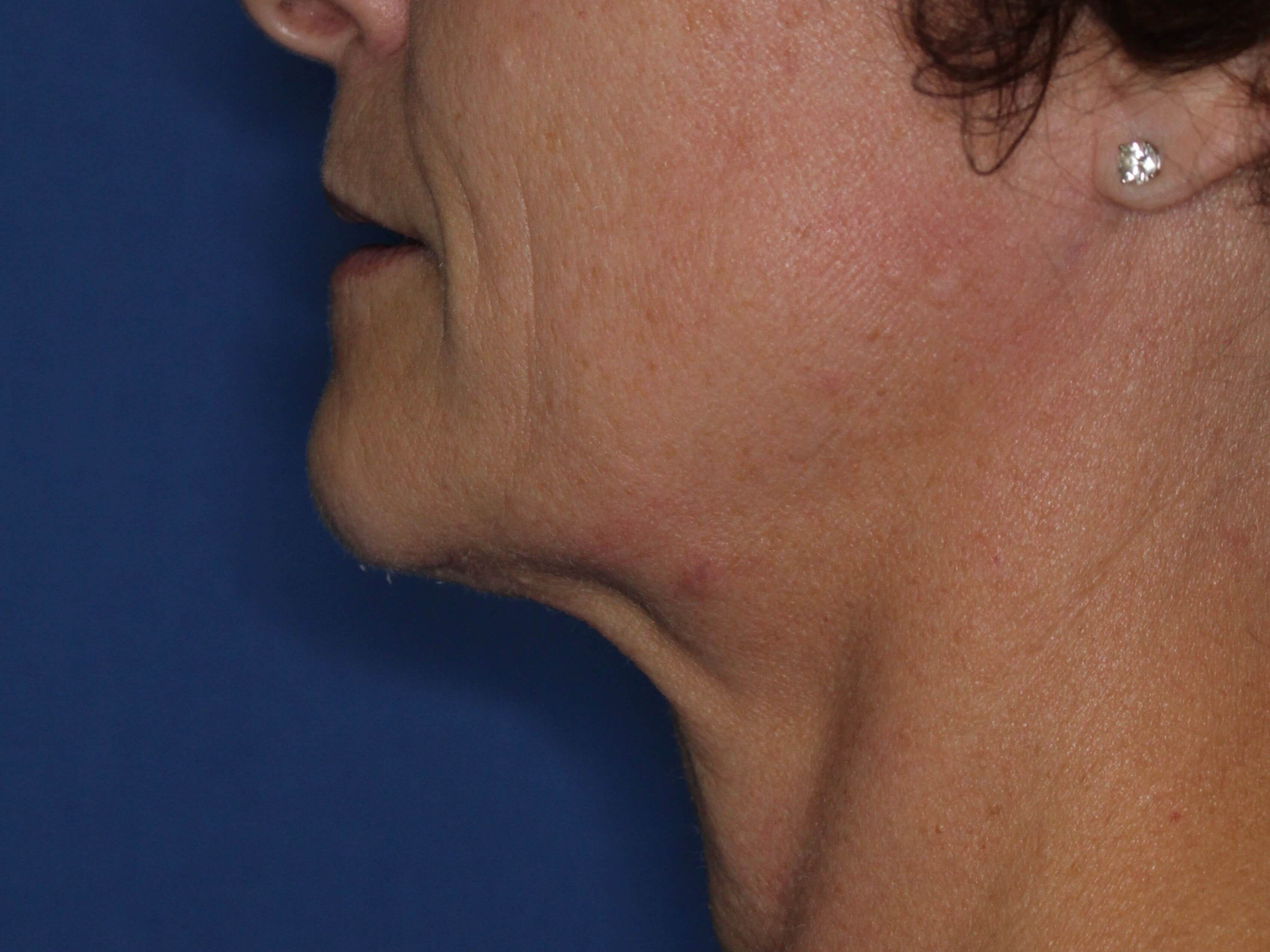Radiofrequency Skin tightening After