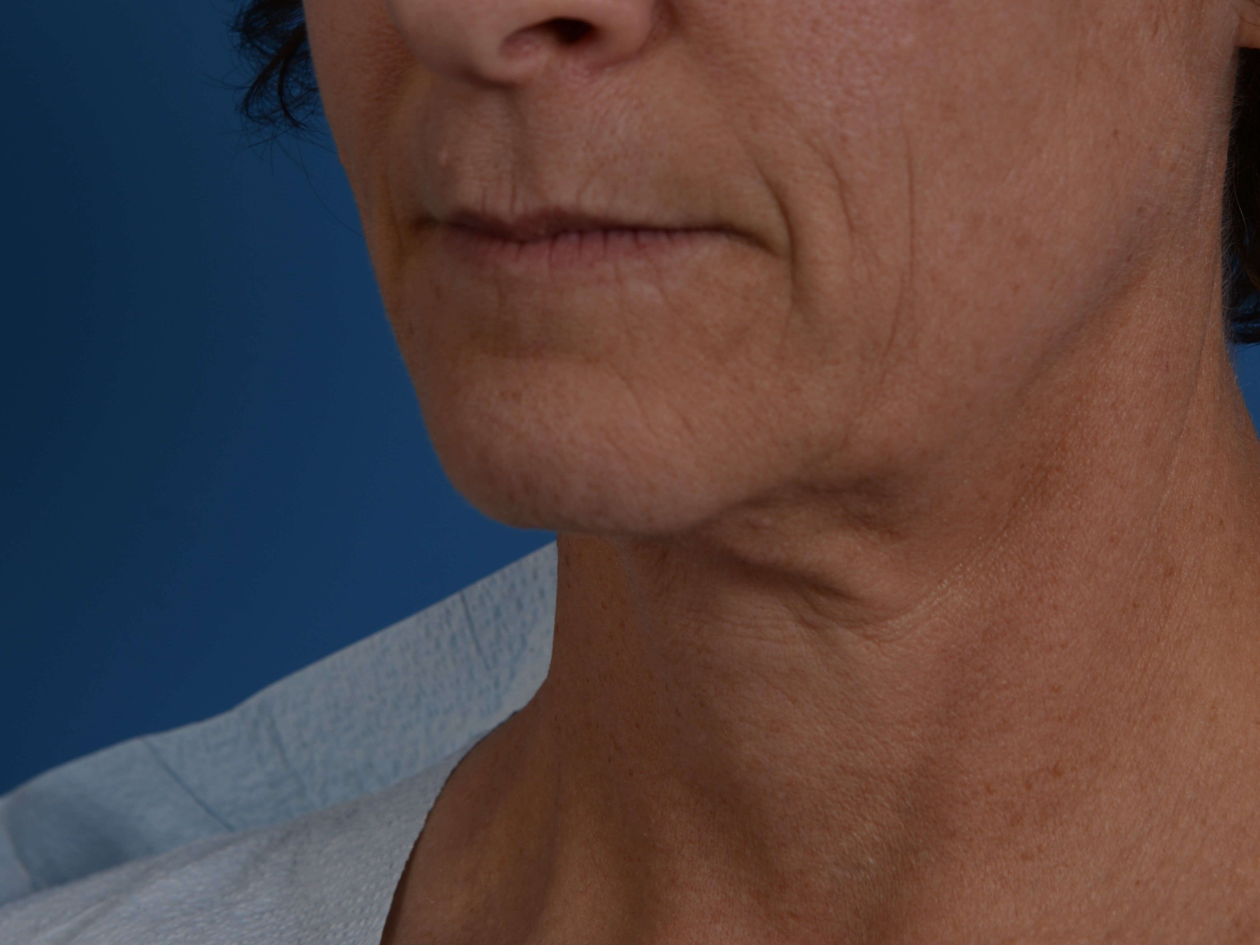 Nonsurgical Skin Tightening Before