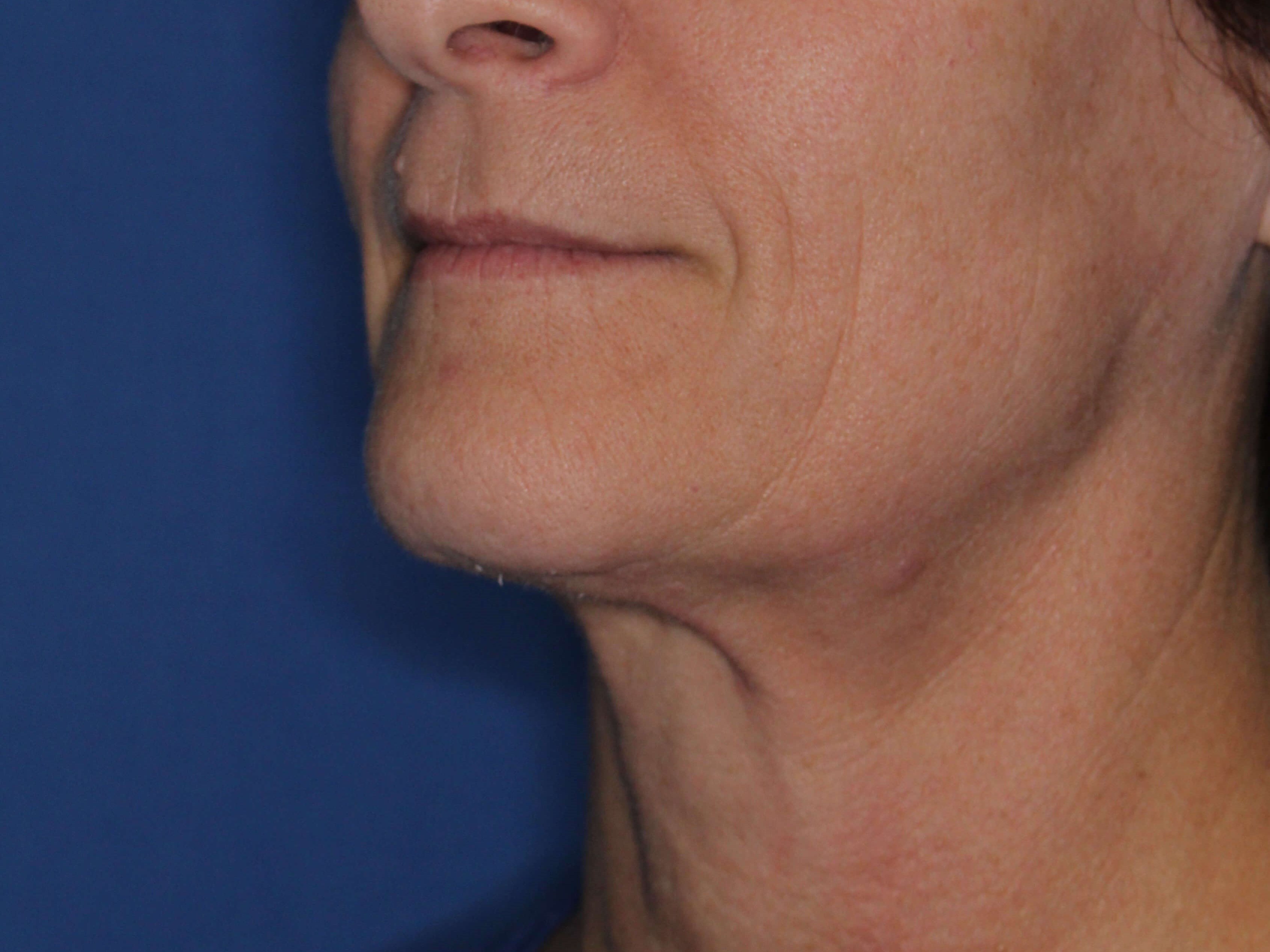Nonsurgical Skin Tightening After