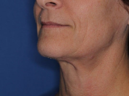 Nonsurgical Skin Tightening After