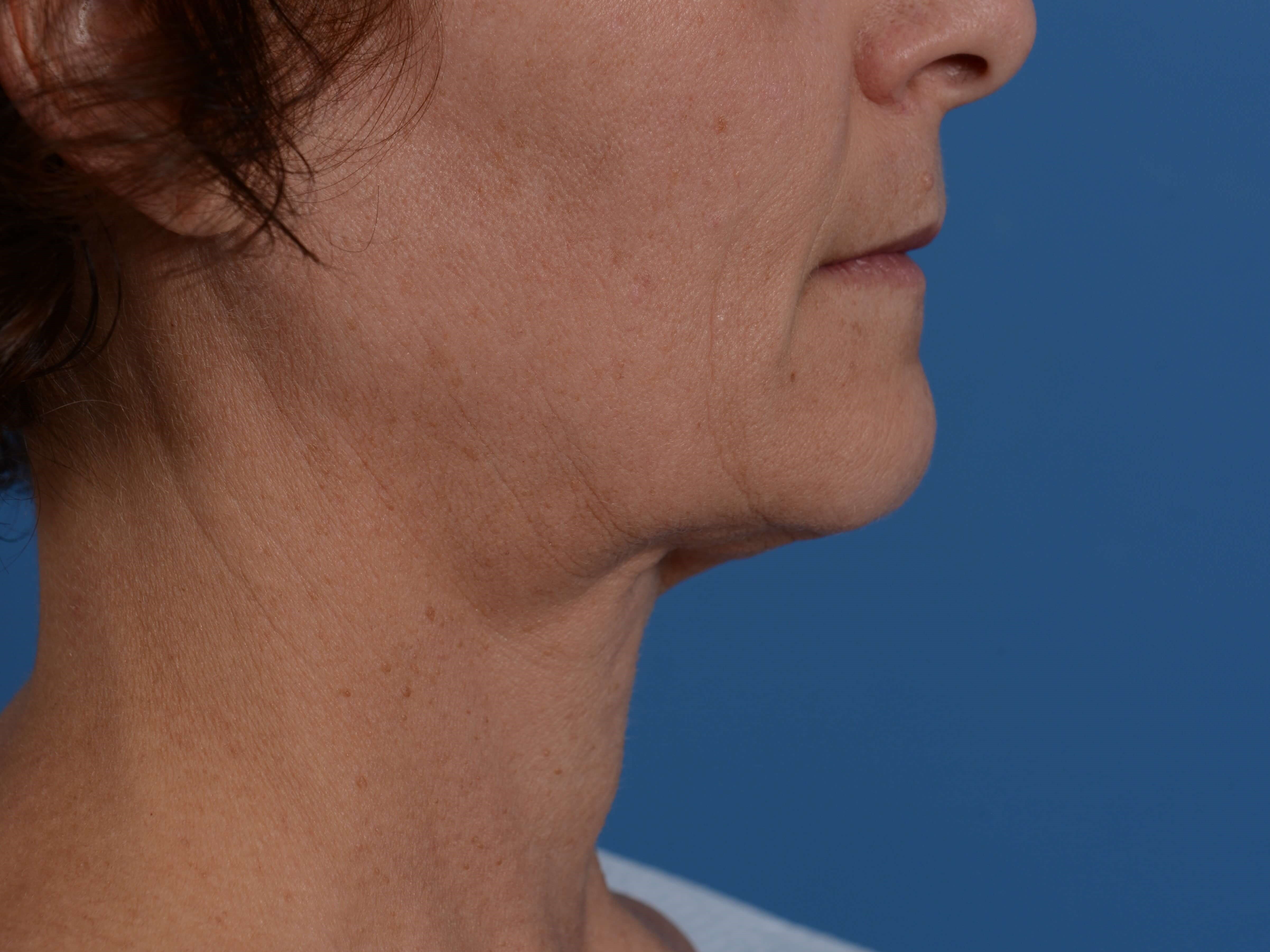 Radiofrequency Skin tightening Before