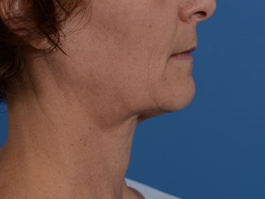 Radiofrequency Skin tightening Before